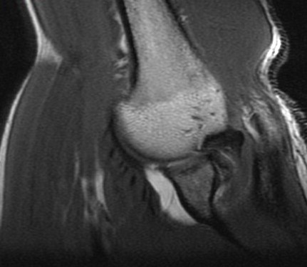 Figure 5 for case Posterior Peel Back Lesion of Internal Impingement